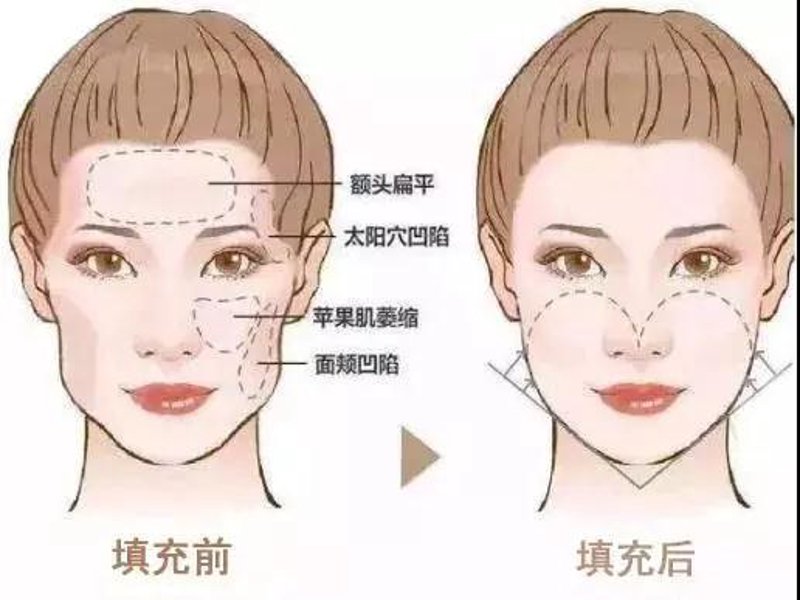 隆鼻手术趋势揭秘:从传统到现代的革新之旅