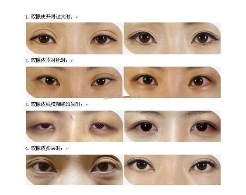 鼻部微整:重塑你的五官魅力